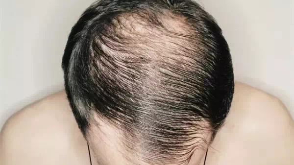 HOW TO OVERCOME BALDNESS IN MEN